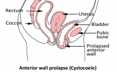 The Biopsychosocial Management of Prolapse: What is it and Why is it Important?